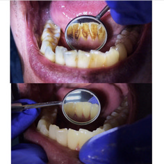 Гигиена полости рта до и сразу после процедуры