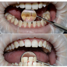 Гигиена полости рта до и сразу после процедуры