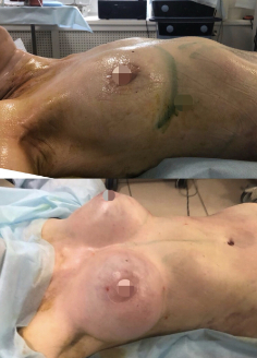Липофилинг груди: «до» и «после» операции