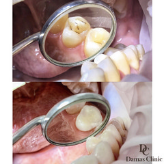Лечение кариеса двух зубов 