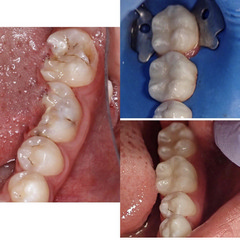Лечение и восстановление трёх зубов 