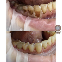 Лечение пришеечного кариеса 4 зубов 