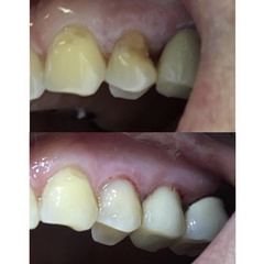 Пришеечный кариес_ 2 зуба до и после