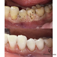 Лечение пришеечного кариеса трёх зубов 