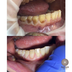 Лечение пришеечного кариеса 4 зубов 