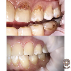 Лечение пришеечного кариеса 3 зубов 