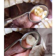 Лечение кариеса коренных зубов 