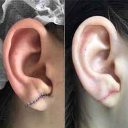 Коррекция мочек уха первичная реабилитация 
