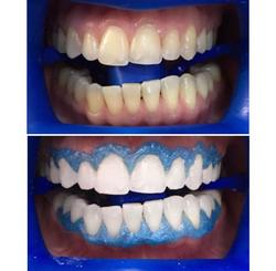 Результат отбеливания зубов Zoom 4 до и сразу после 