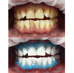 Результат отбеливания зубов Zoom 4 до и сразу после 
