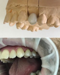 Примерка керамической коронки на зуб 