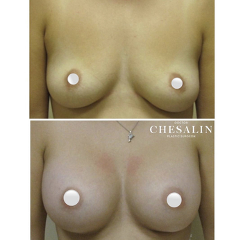 Увеличение груди анатомическими имплантами- до и после