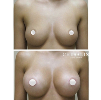 Увеличение груди анатомическими имплантами: до и после