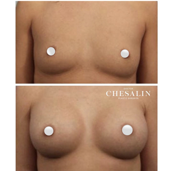 Увеличение груди анатомическими имплантами: до и после