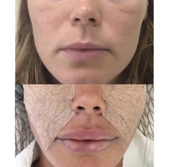 Липоскульптурирование (липофилинг) лица: губы, носогубные складки, скуловая область - до и сразу после операции