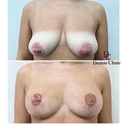 Якорная подтяжка груди с пластикой сосков: до и на 10 сутки после. Без имплантов