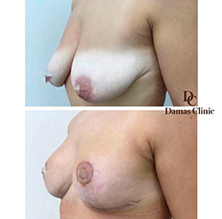 Якорная подтяжка груди с пластикой сосков: до и на 10 сутки после. Без имплантов