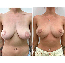 Якорная подтяжка груди с пластикой сосков: до и на 14 сутки после. Без имплантов