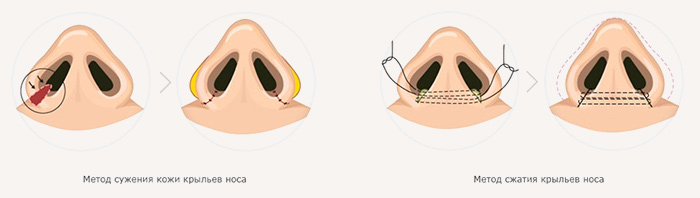 Схема операции по коррекции ноздрей