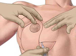 Разрезы при якорной подтяжке груди