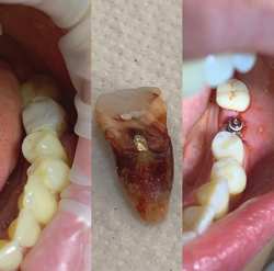 Удаление периодонтитного зуба с одномоментной имплантацией