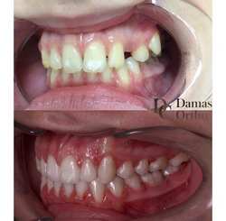 Результат ортодонтического лечения до и после