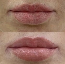 Пластика губ «Кессельринг»: 14 дней с момента операции. Работа Анны Петровны Першуковой
