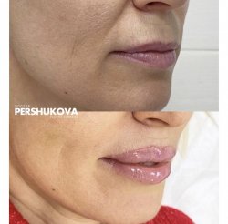 Пластика губ «Кессельринг»: первичная реабилитация. Работа Анны Петровны Першуковой