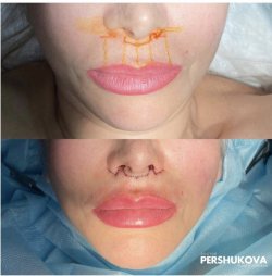 Пластика губ «Булхорн»: до и сразу после операции. Работа Анны Петровны Першуковой