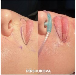 Пластика губ «Кессельринг» + пластика губ «Corner lift»: до и сразу после операции. Работа Анны Петровны Першуковой