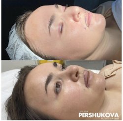 Пластика губ «Кессельринг»: до и на 6 сутки после операции. Работа Анны Петровны Першуковой