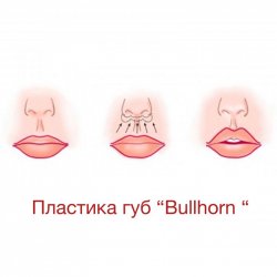 Пластика губ «Bulhorn»