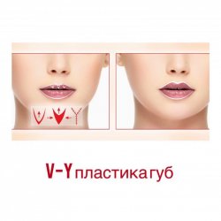 Пластика губ V-Y