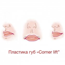Пластика губ «Corner Lift»