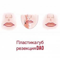 Пластика губ «Резекция Dao»
