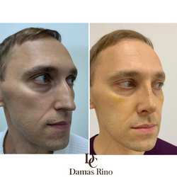 Фото мужской ринопластики до и на 10 сутки после операции. Работа доктора Лины Исбир