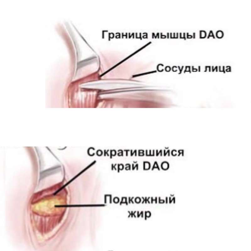 Выделение наружнего края DAO и резекция мышцы