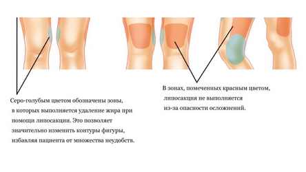 Зоны удаления избытка жировой ткани в области коленок