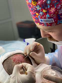 Процесс трансплантации волос в зону макушки