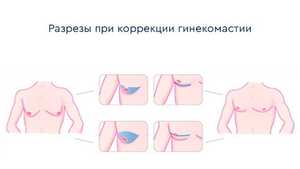 Разрезы при гинекомастии