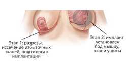 Основные этапы эндопротезирования груди с одномоментной подтяжкой
