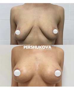 Подтяжка груди по ареоле с имплантами. Работа Анны Петровны Першуковой