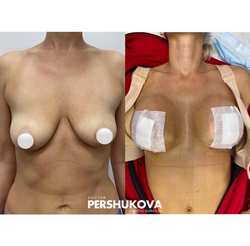 Подтяжка груди якорная с имплантами: 2 день после операции. Работа Анны Петровны Першуковой