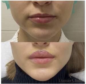 Пластика губ «Кессельринг» до и после: 4 дня с момента операции (еще не сняли швы). Работа Анны Петровны Першуковой