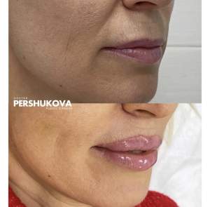Пластика губ «Кессельринг» до и после: 6 сутки. Работа Анны Петровны Першуковой