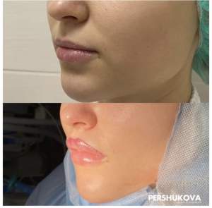 Пластика губ «Кессельринг» до и сразу после операции. Работа Анны Петровны Першуковой