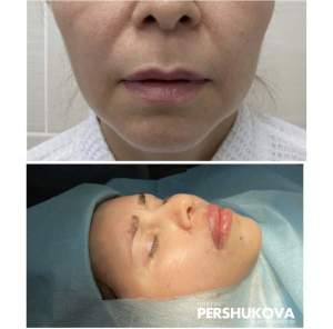 Пластика губ «Кессельринг» до и сразу после операции. Работа Анны Петровны Першуковой