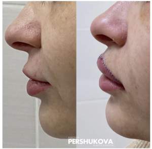 Пластика губ «Кессельринг» до и после: 4 стуки. Работа Анны Петровны Першуковой