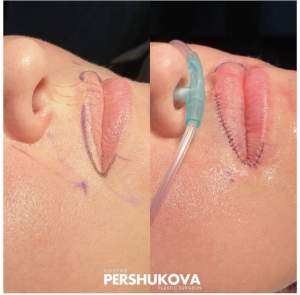 Пластика губ «Кессельринг» + Corner Lift: до и сразу после операции. Работа Анны Петровны Першуковой