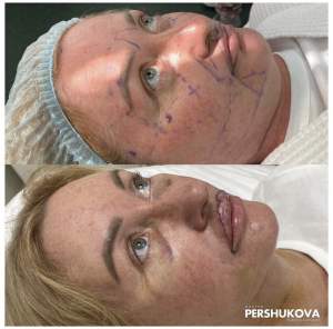 Пластика губ «Кессельринг» до и на 5 стуки после операции. Работа Анны Петровны Першуковой